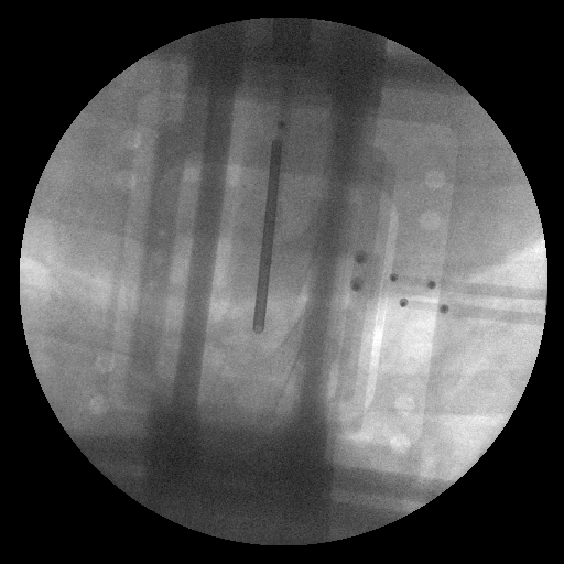 <p>Position of therapeutic needles after placed by AUTO-Spine imaged on MRI</p>