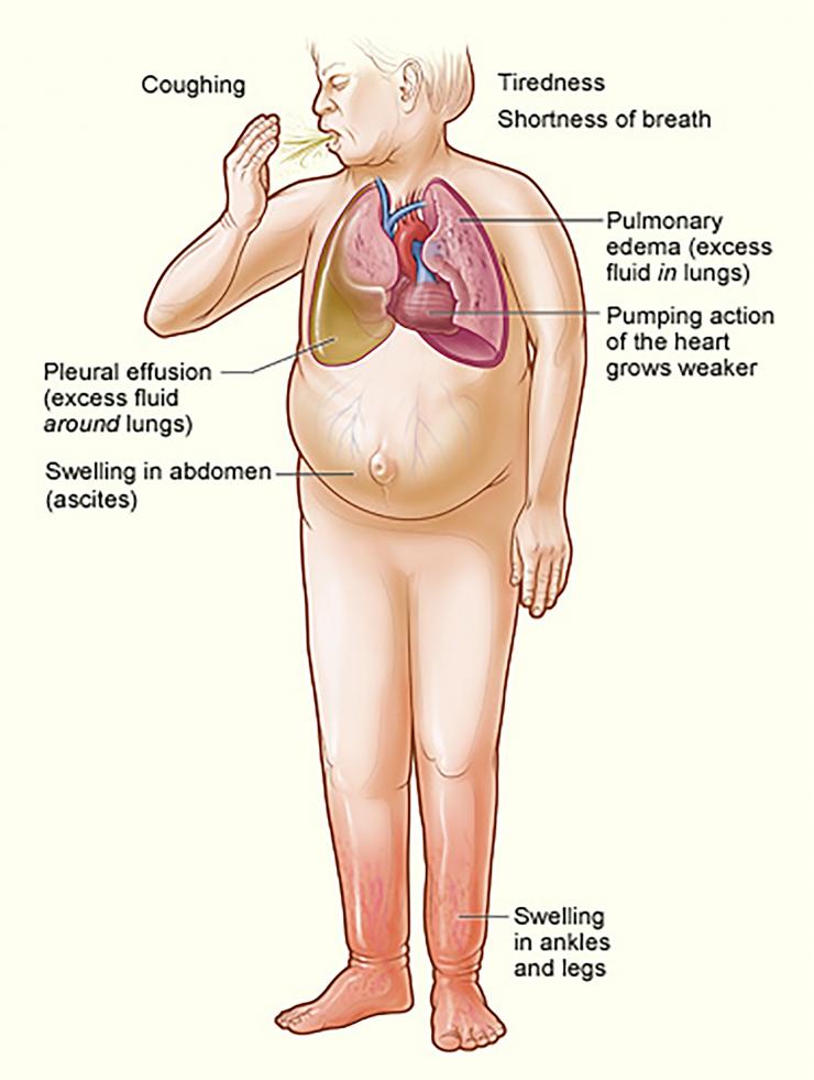 <p>Symptoms of heart failure. Credit: National Institutes of Health, National Heart, Lung and Blood Institute</p>