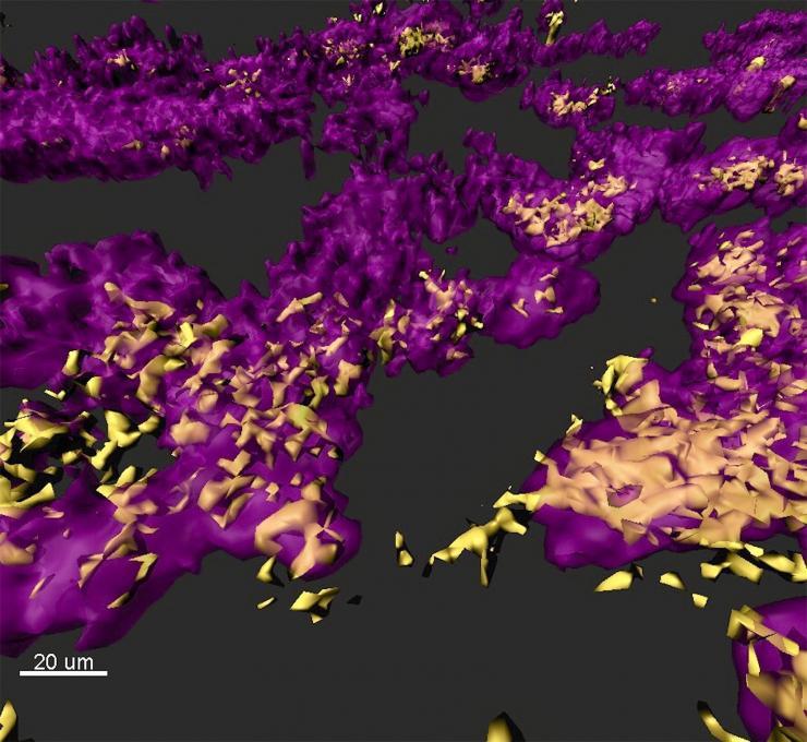 <p>Image shows a rendered confocal laser scanning micrograph of a mixed species bacterial biofilm observed in a chronic wound model of infection. Staphylococcus aureus (yellow) and Pseudomonas aeruginosa (purple), organize themselves in small, dense clusters of cells called aggregates. (Credit: Sophie Darch, Whiteley Lab and Rumbaugh Lab at Texas Tech University Health Sciences Center.)</p>